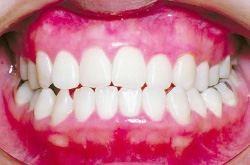 受け口(反対咬合・下顎前突)2